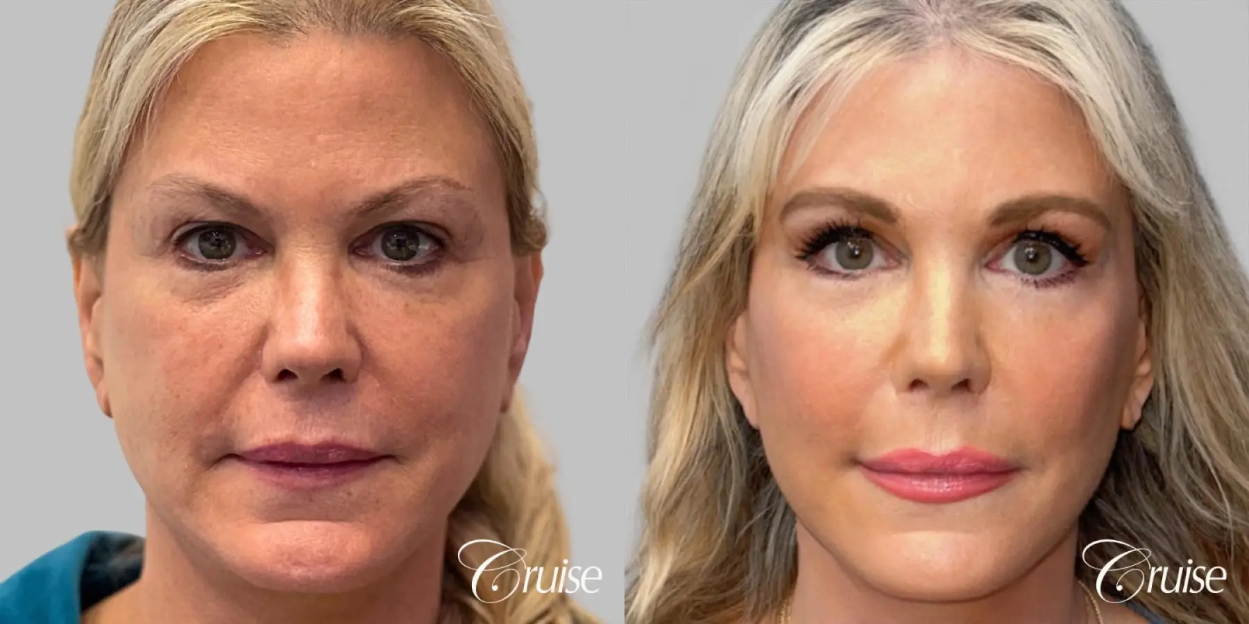 Female Fat Transfer - Cheeks, Upper and Lower Lips - Before and After 1