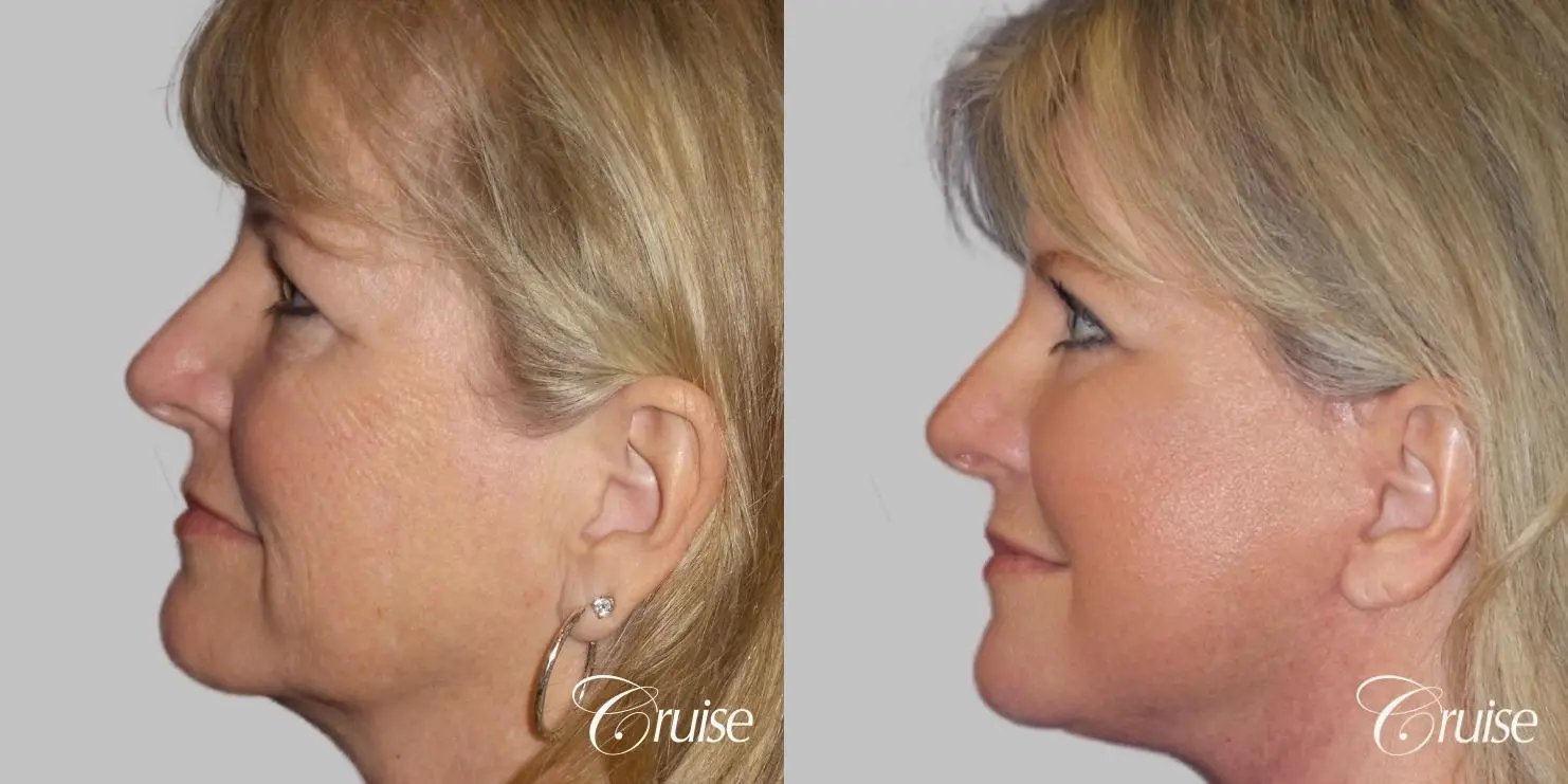 Face Lift surgery Newport Beach Orange County - Before and After 3