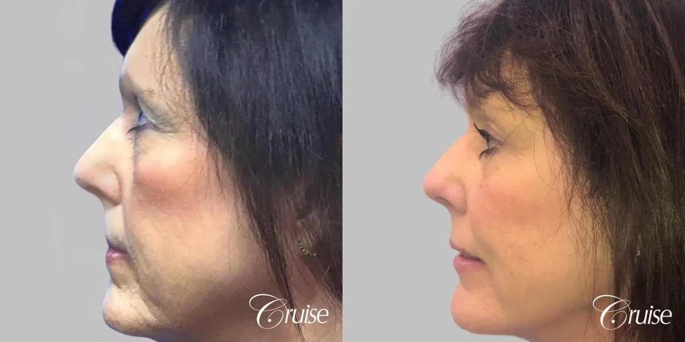 Facelift in Newport Beach, CA - Before and After 3