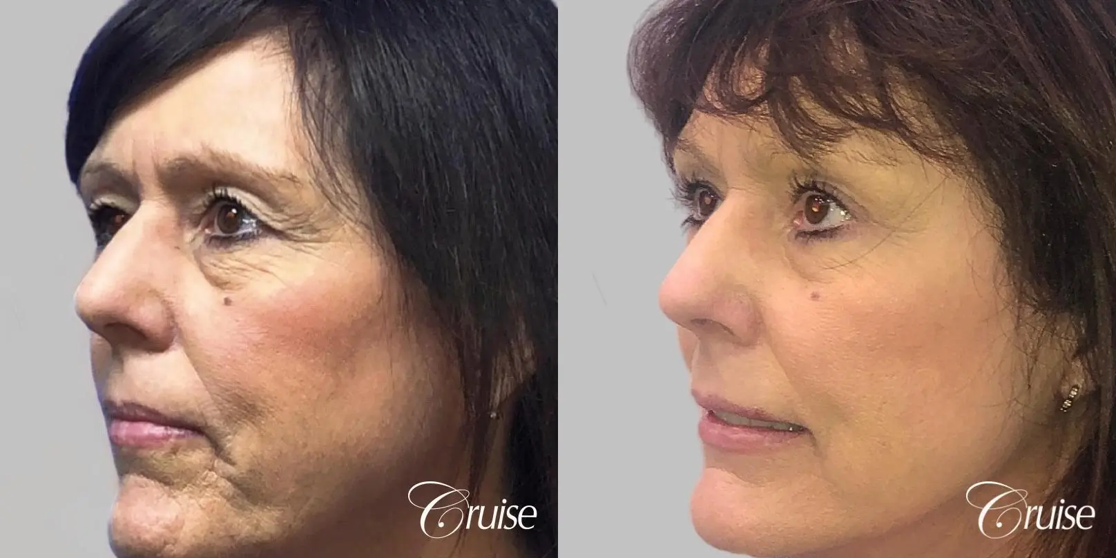 Facelift in Newport Beach, CA - Before and After 2