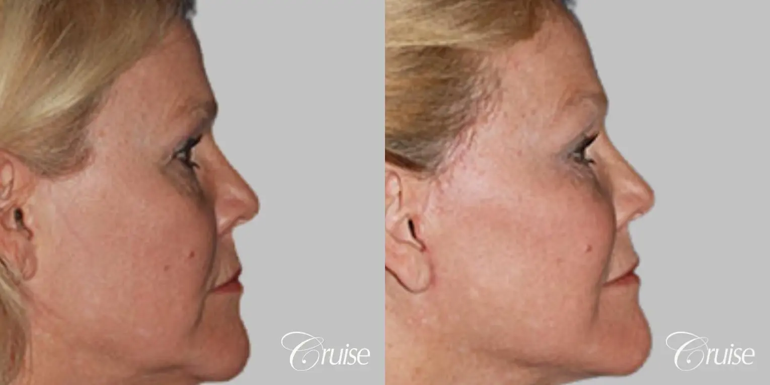 Facelift in Newport Beach, CA - Before and After 3