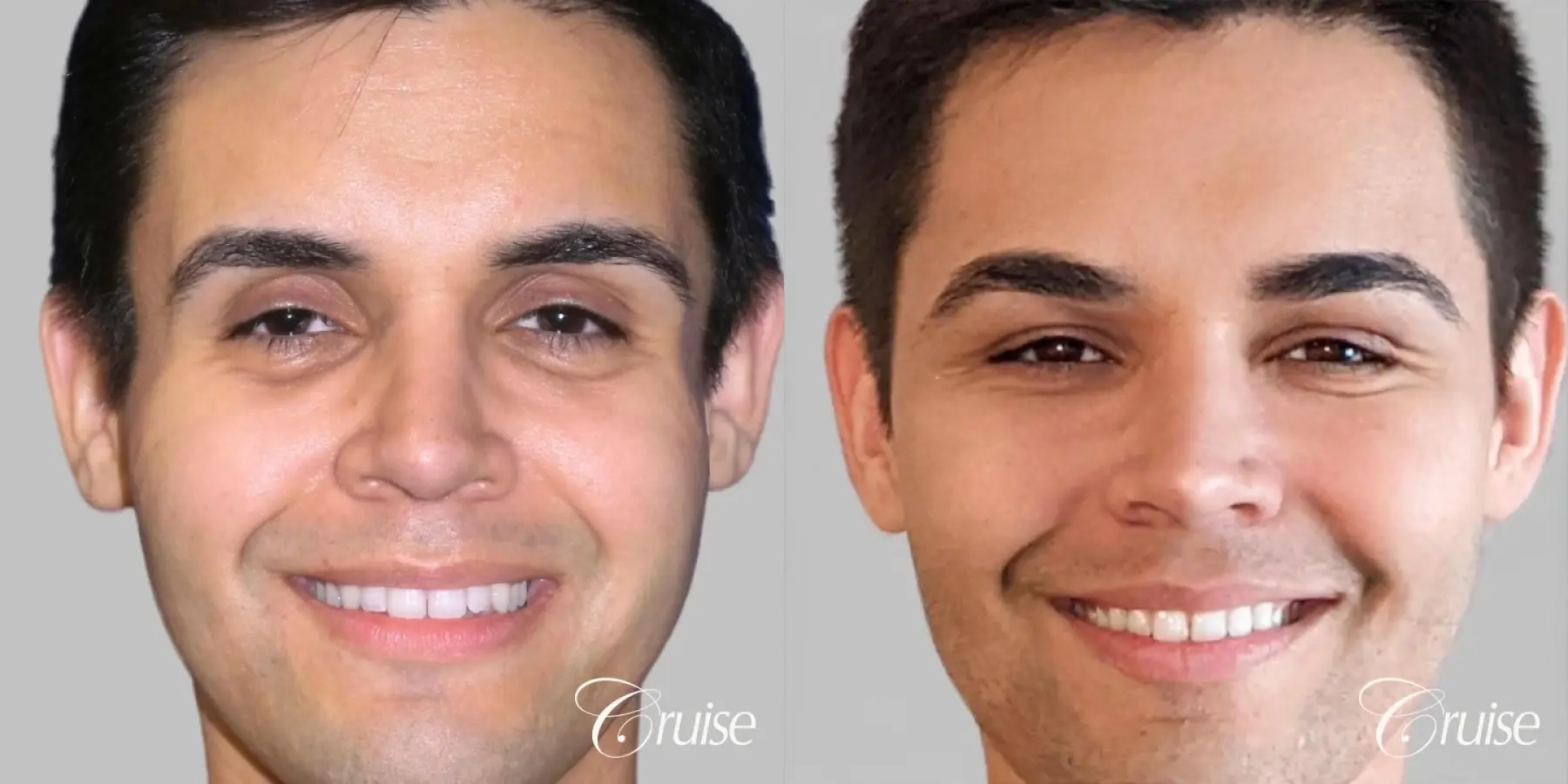 Male - Fat Transfer to Cheeks, Temple, and Tear Trough - Before and After  