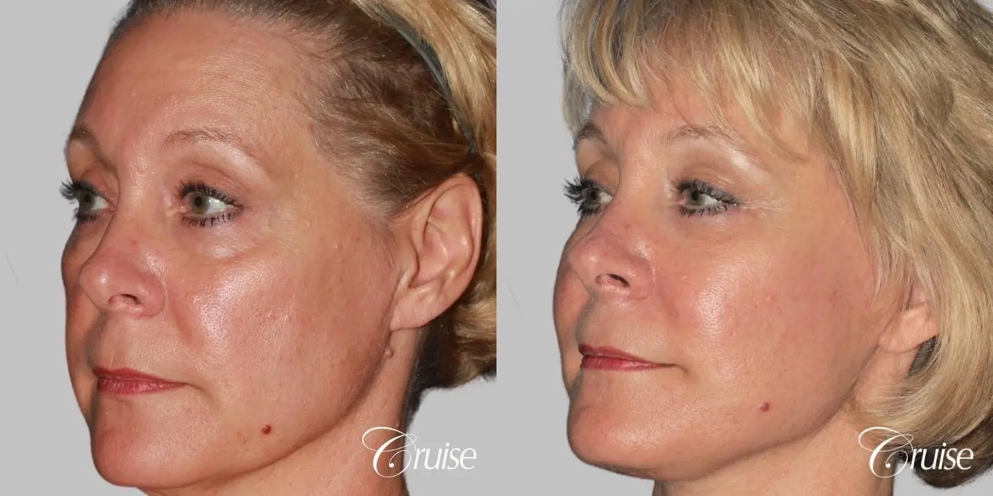 Female Facelift, Temple Lift, Fat Transfer, Neck Lift - Before and After 2