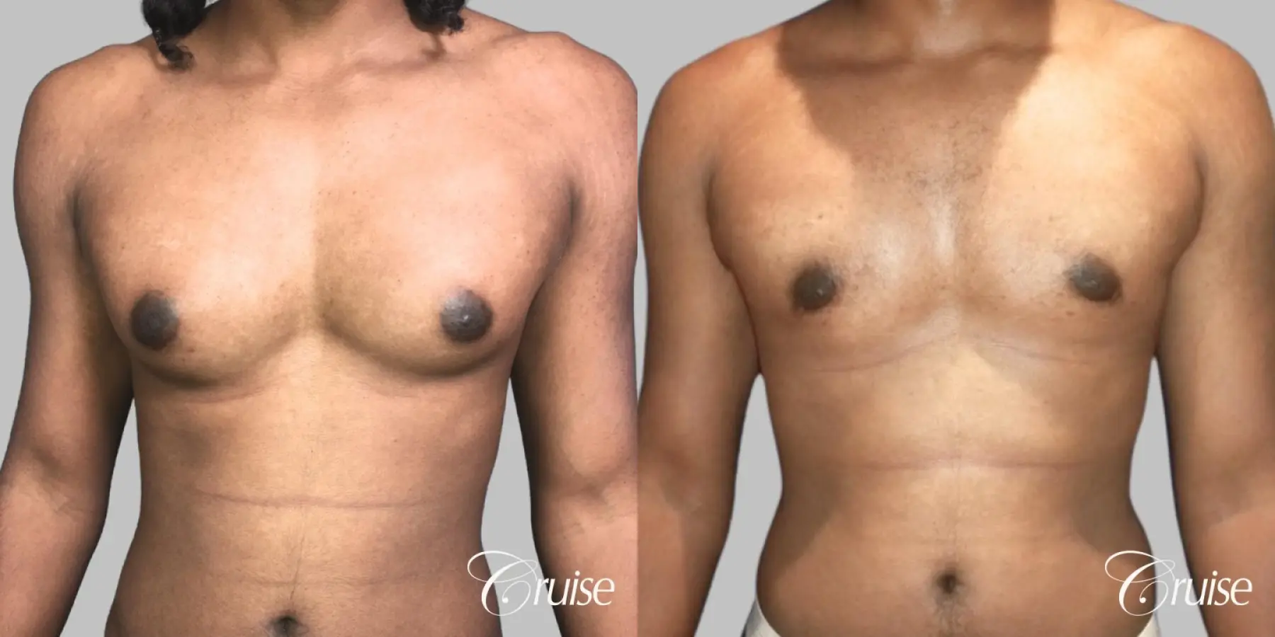 Type 3 Gynecomastia Gland Removal & Skin Tightening - Before and After 1