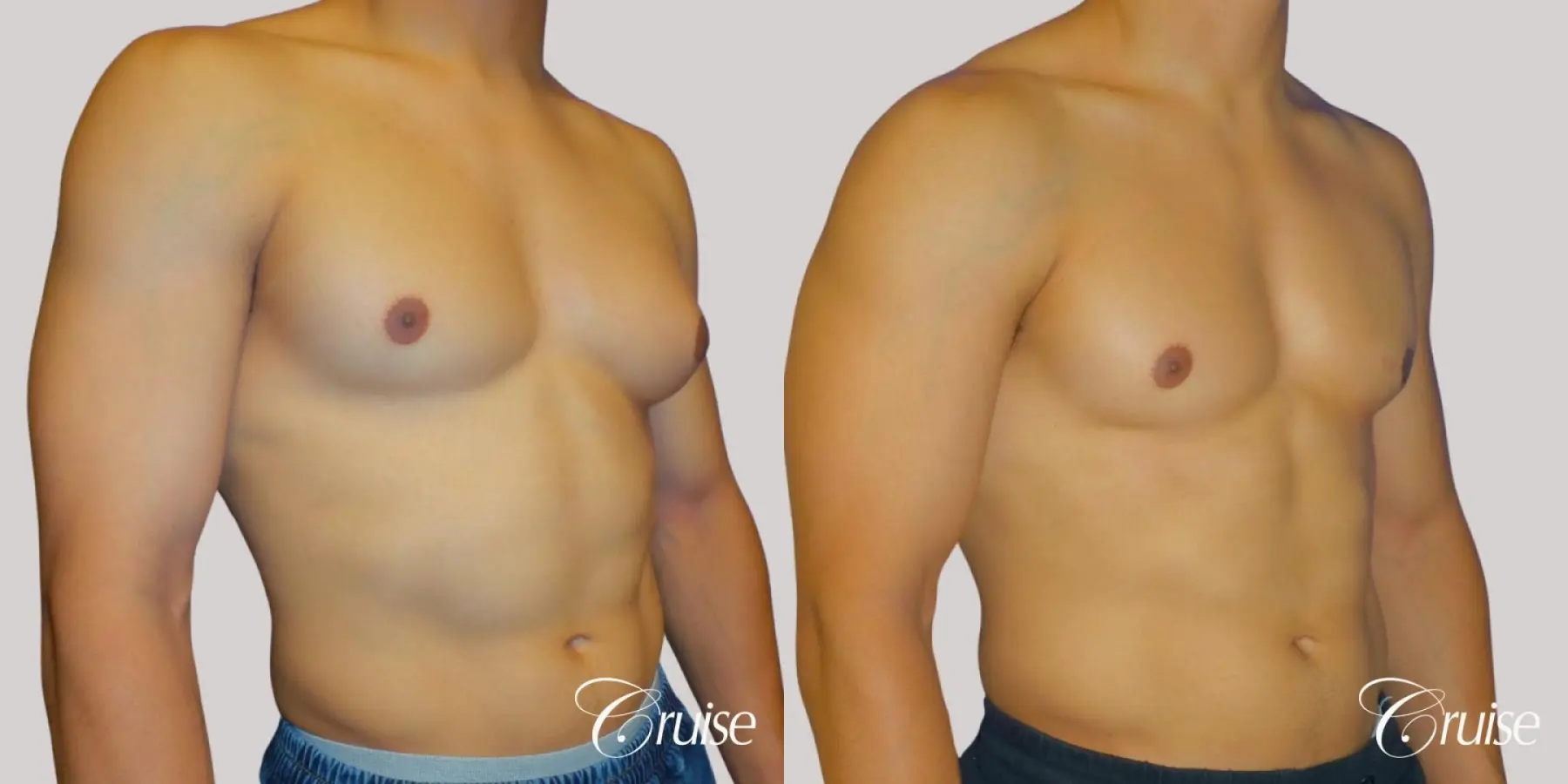 Unilateral gynecomastia before and after - Before and After 4