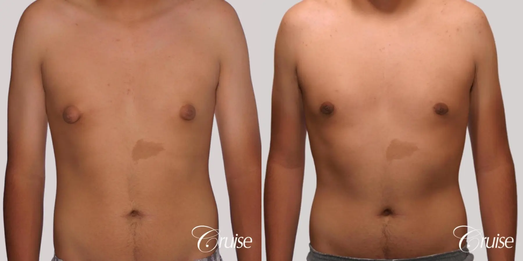 gynecomastia patient gets nipple reduction for best results - Before and After