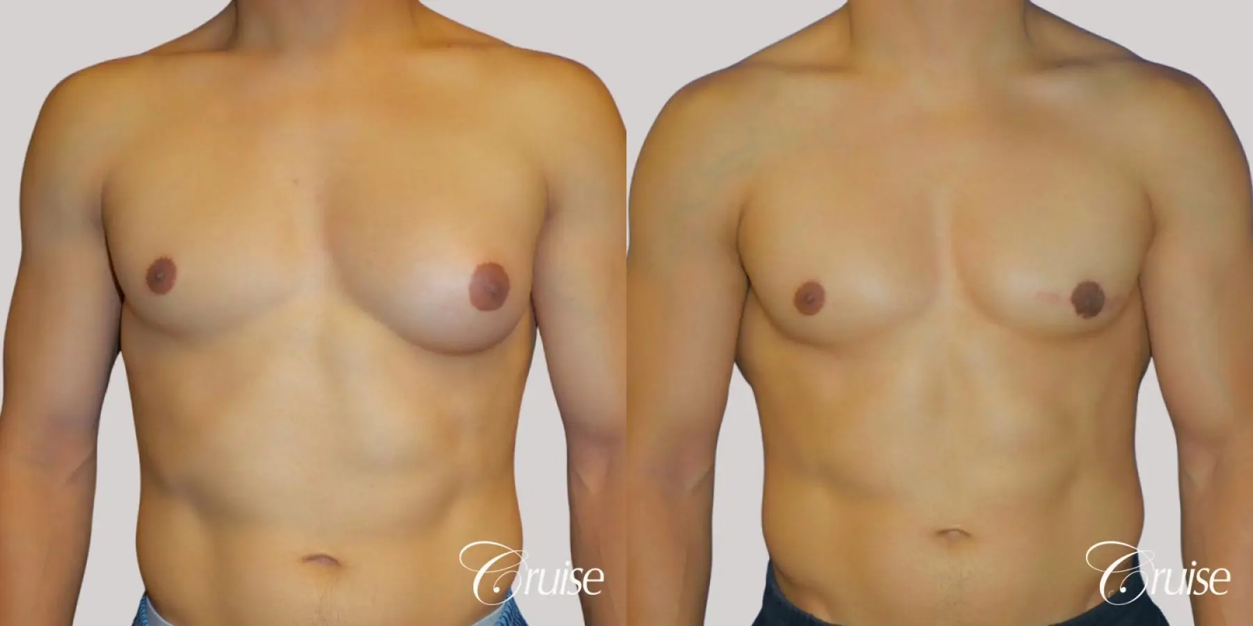 Unilateral gynecomastia before and after - Before and After 1