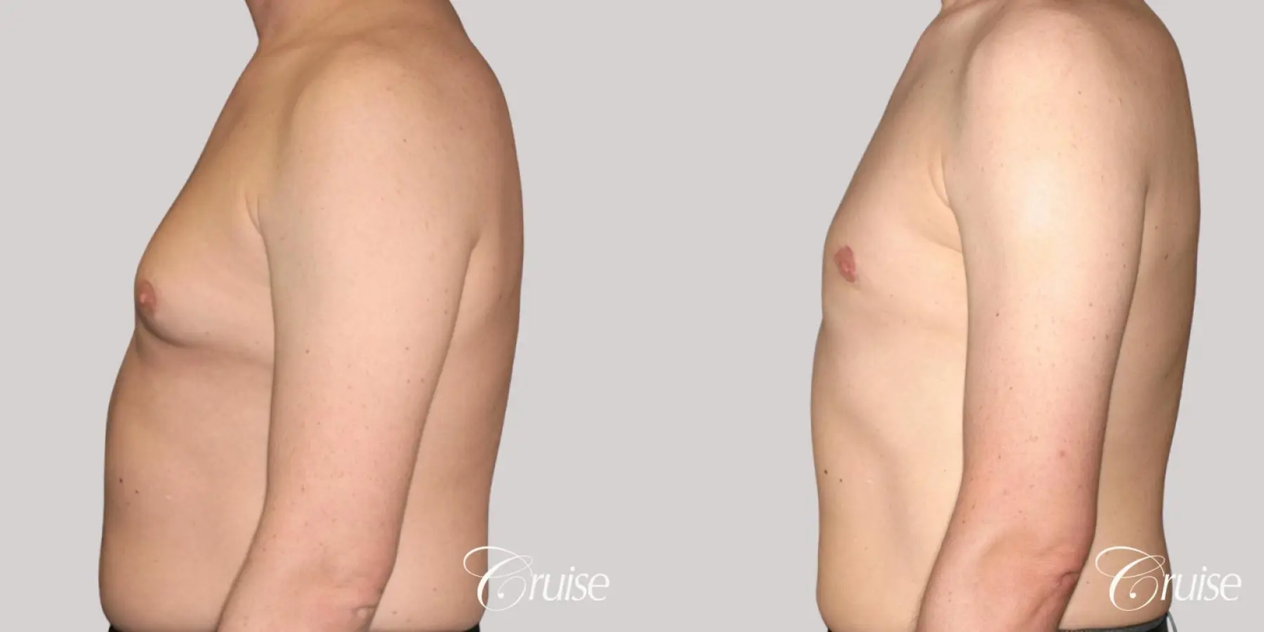 moderate gynecomastia on adult with donut lift scar - Before and After 2