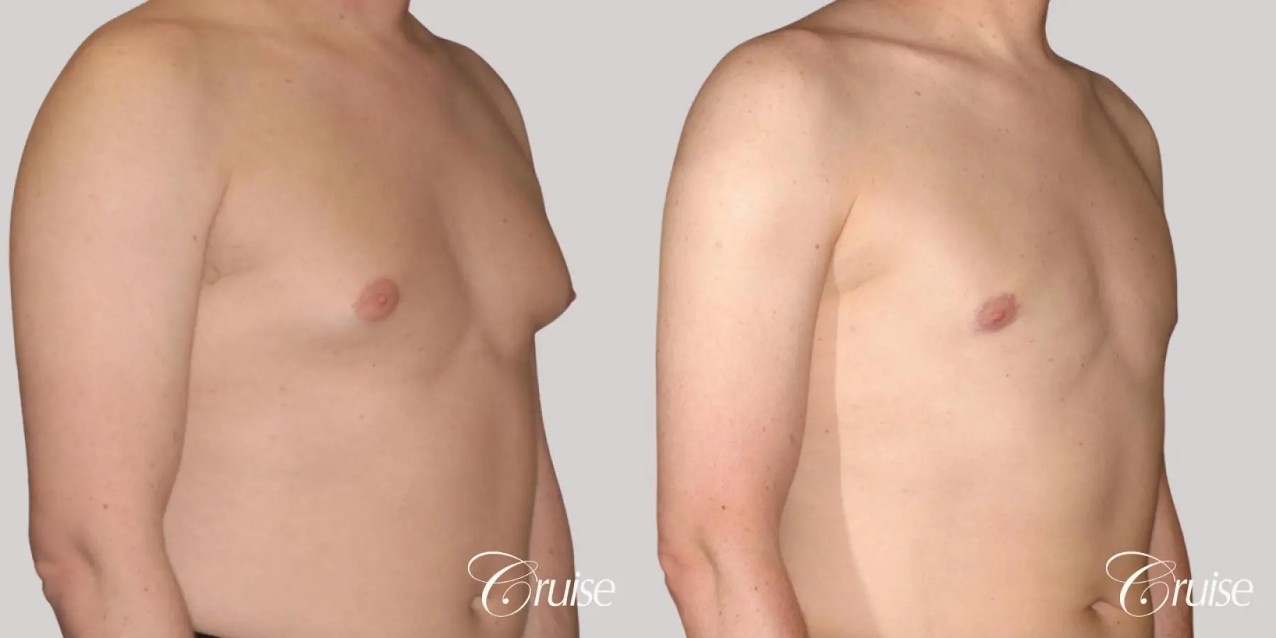 moderate gynecomastia on adult with donut lift scar - Before and After 3