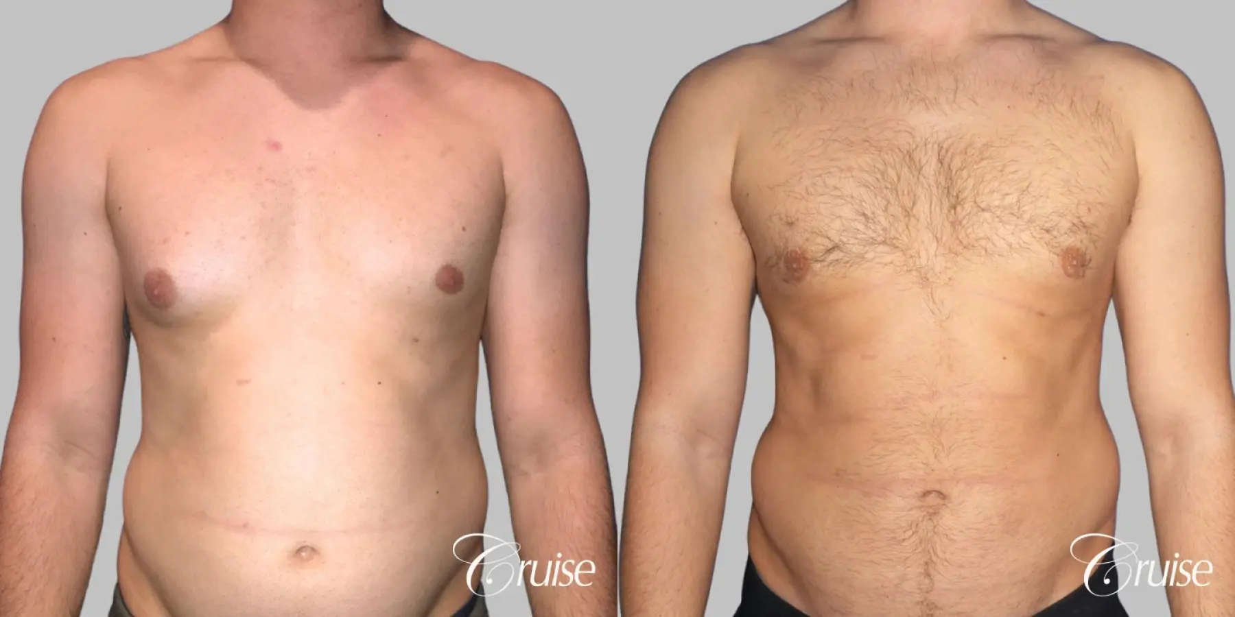 Type 2/3 Asymmetric Gynecomastia  - Before and After 1