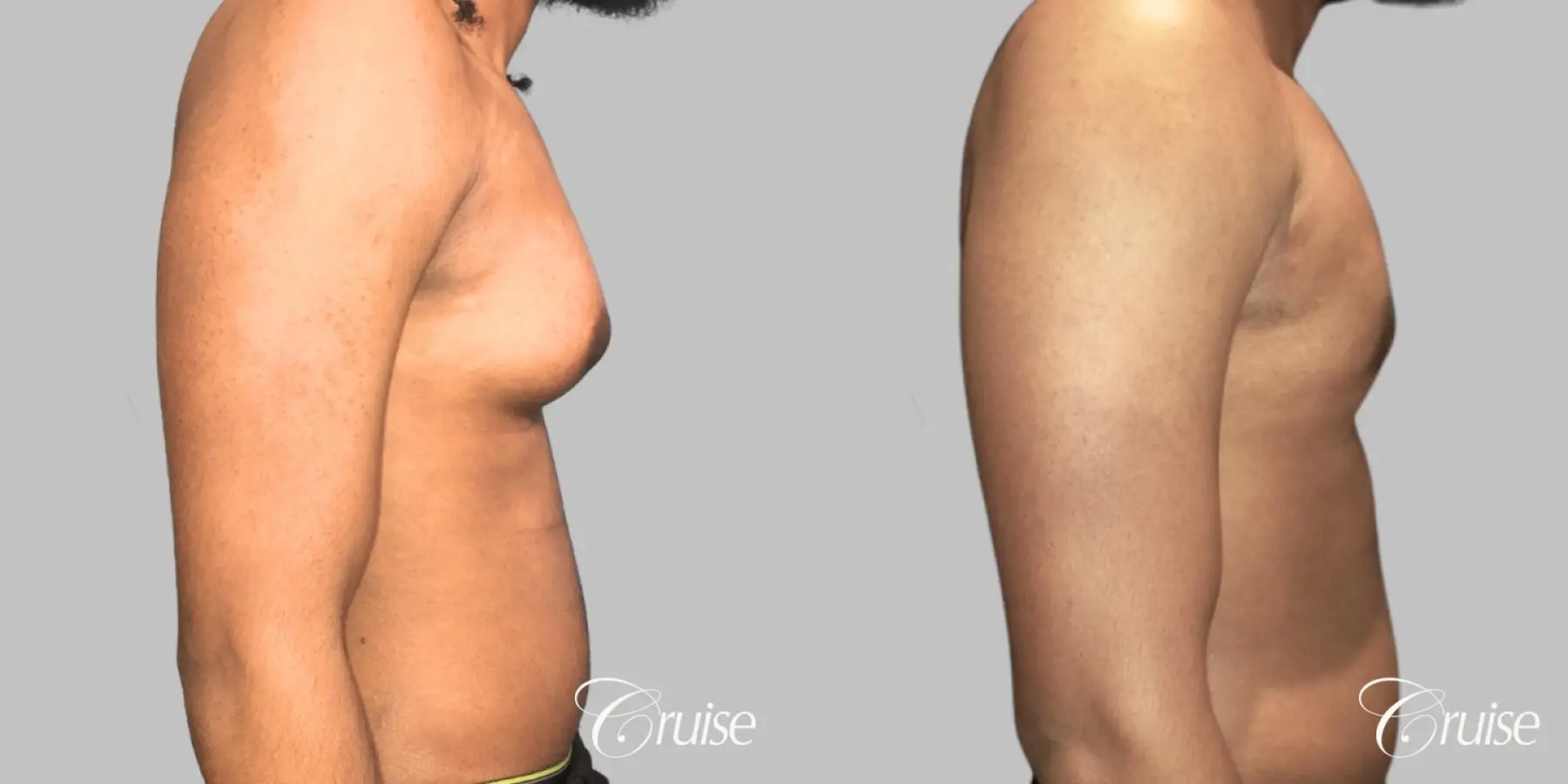 Type 3 Gynecomastia Gland Removal & Skin Tightening - Before and After 4