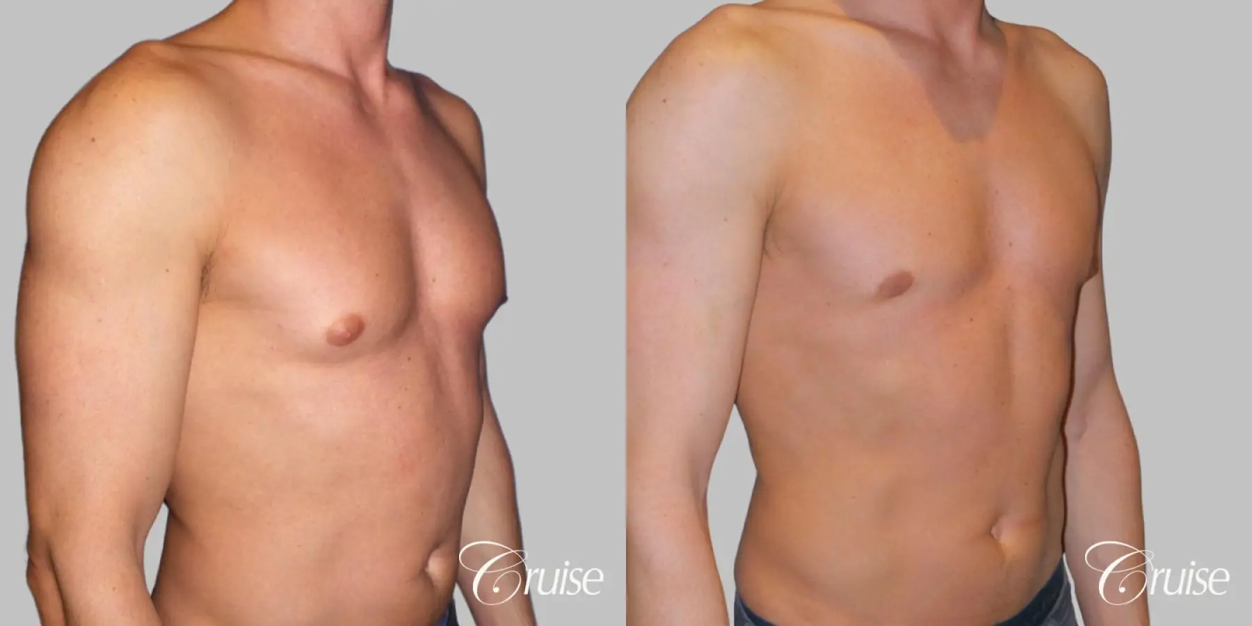 Type 1.5 Puffy Nipple Gynecomastia - Before and After 2