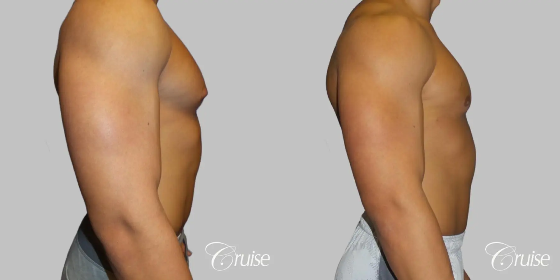 bodybuilder with gynecomastia - Before and After 3