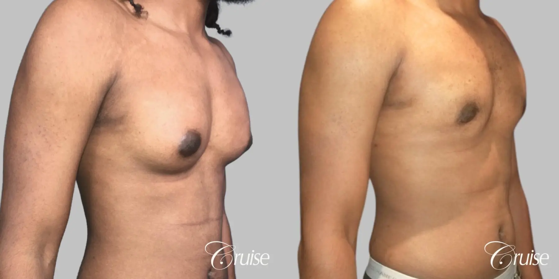 Type 3 Gynecomastia Gland Removal & Skin Tightening - Before and After 3