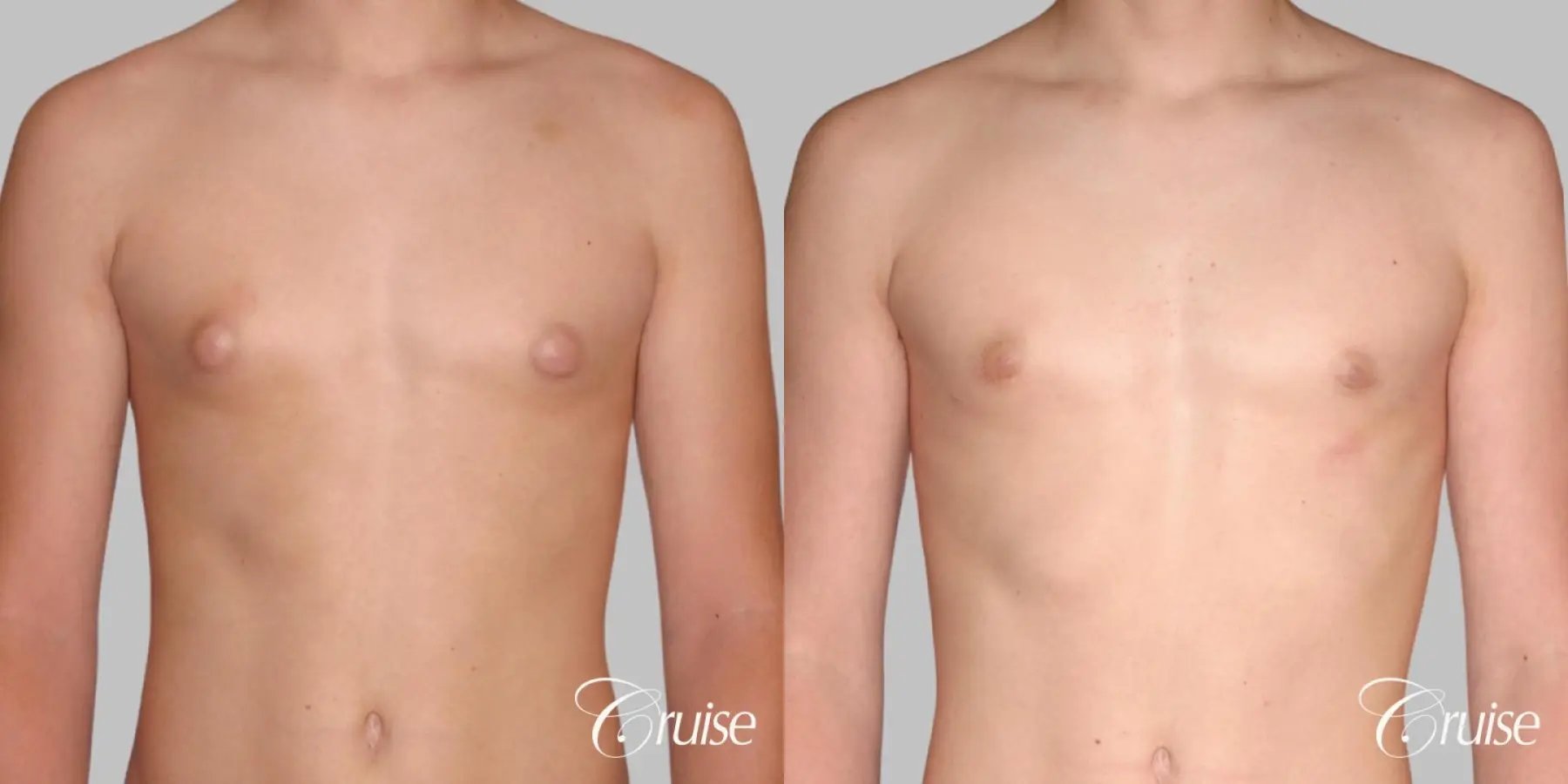 teenage gynecomastia with puffy nipple - Before and After 1