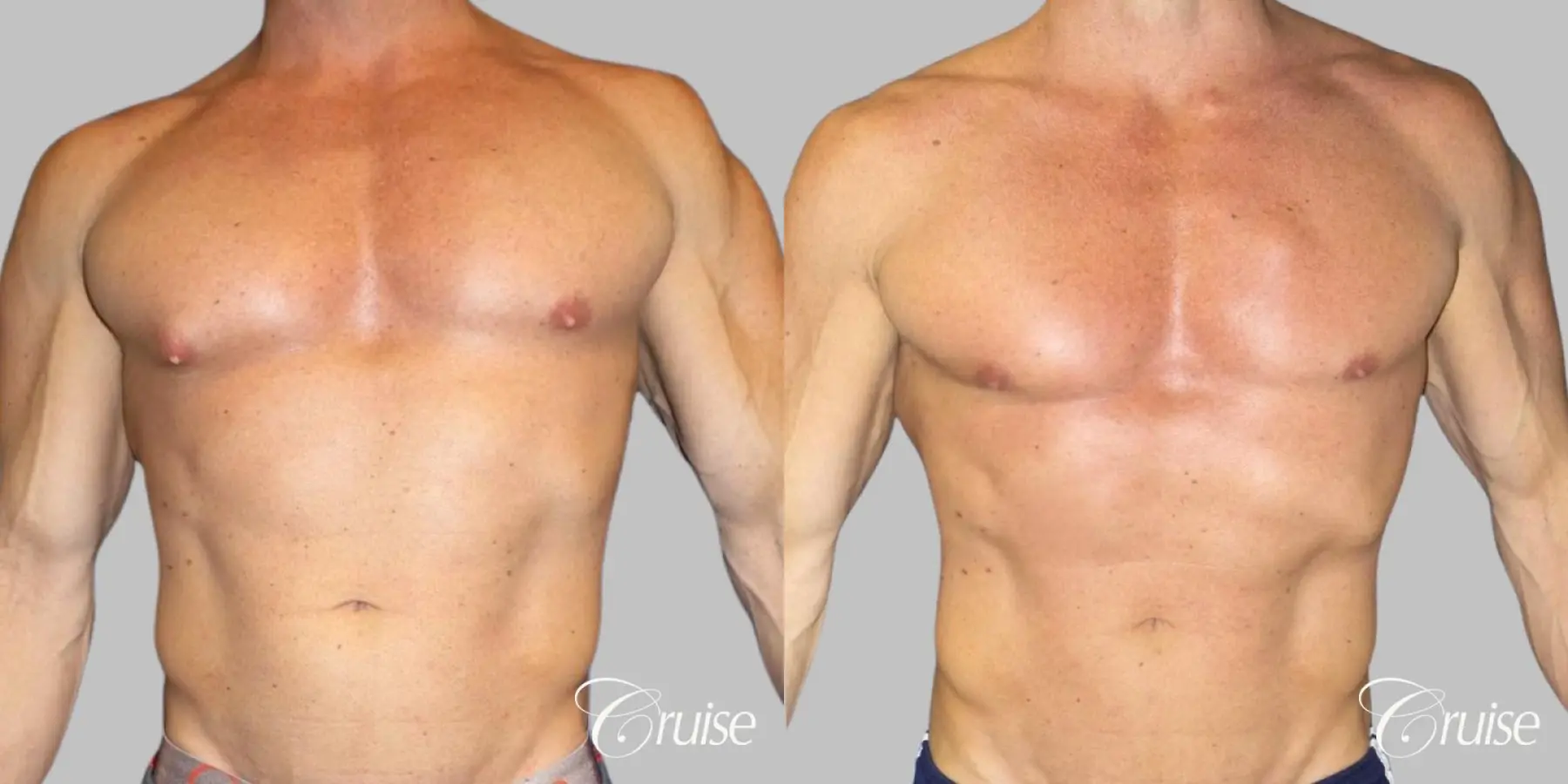 Body builder gynecomastia before and after pictures - Before and After