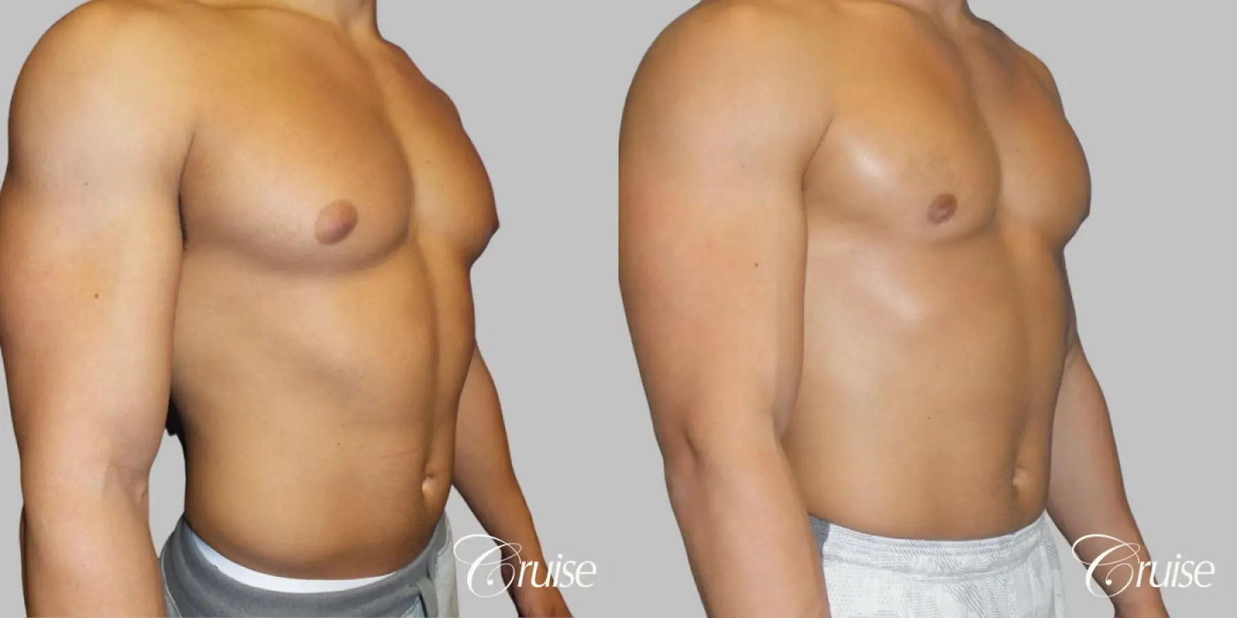 bodybuilder with gynecomastia - Before and After 2