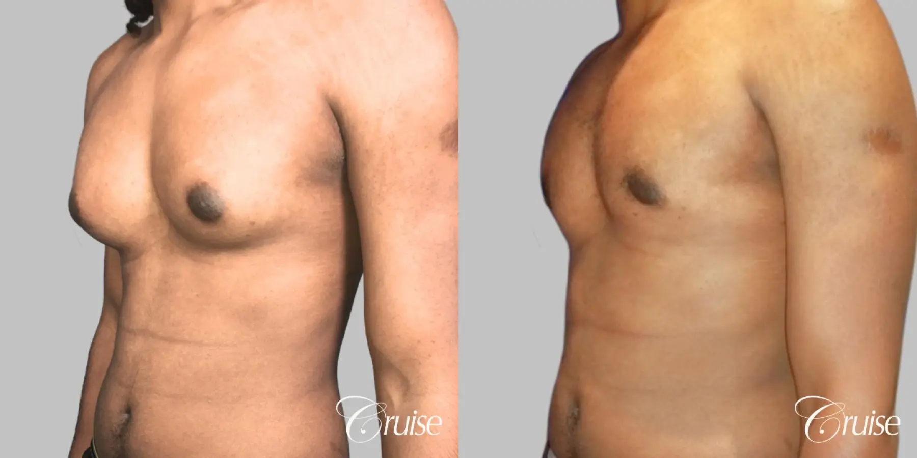 Type 3 Gynecomastia Gland Removal & Skin Tightening - Before and After 2