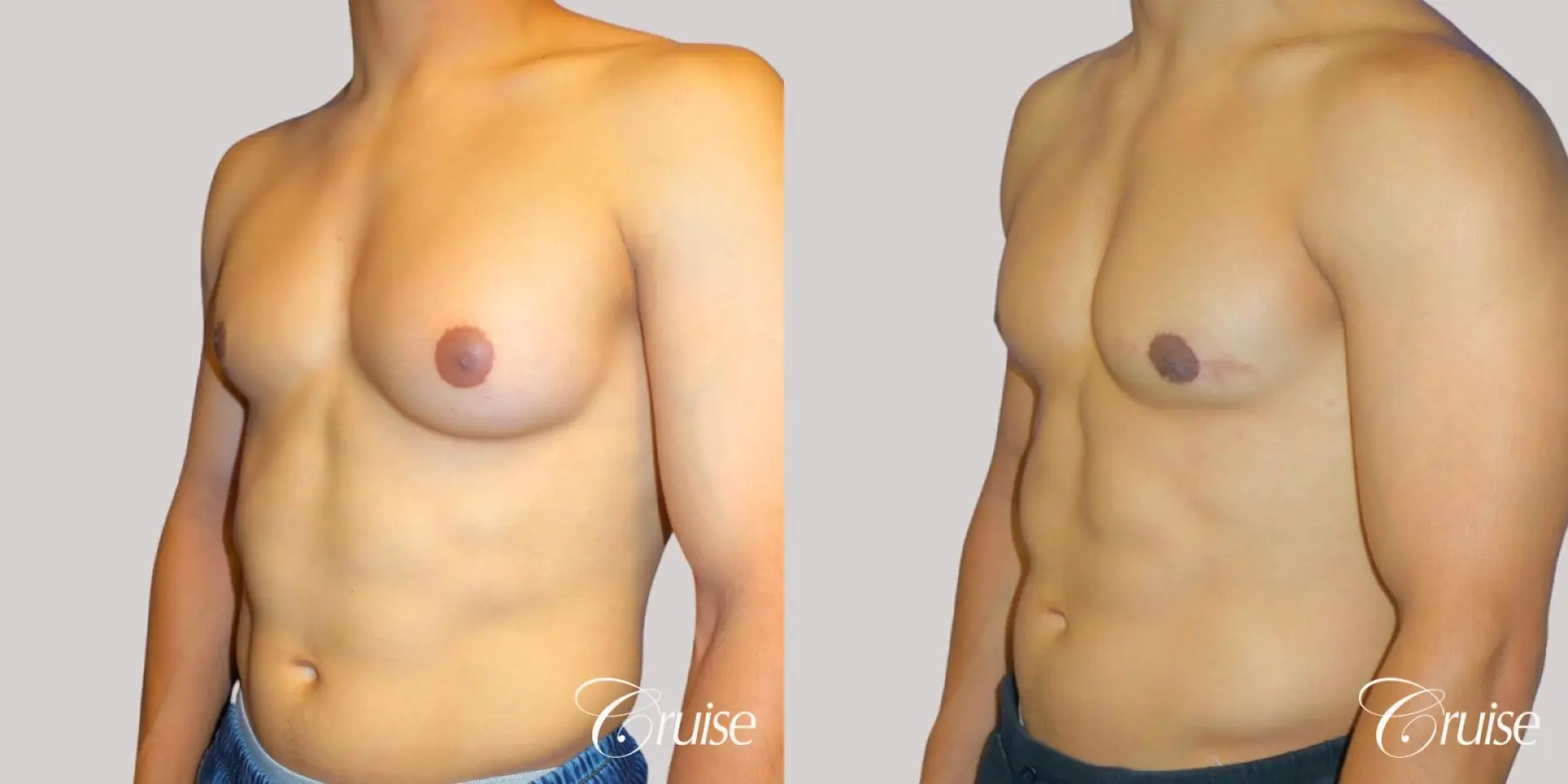 Unilateral gynecomastia before and after - Before and After 2