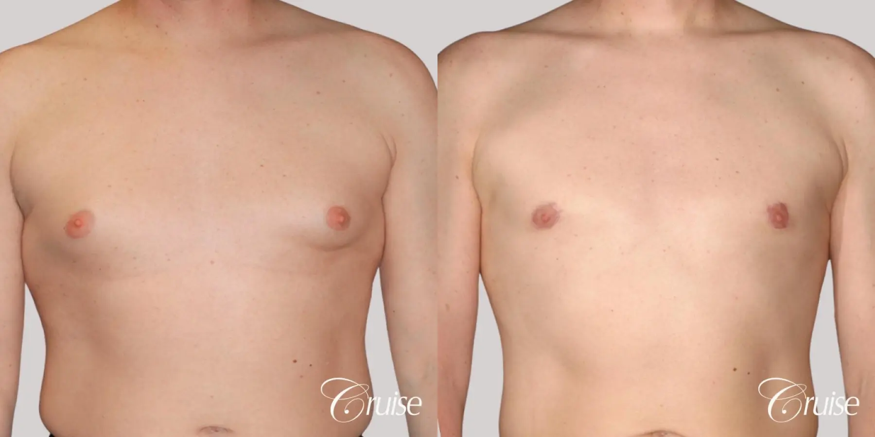 moderate gynecomastia on adult with donut lift scar - Before and After 1