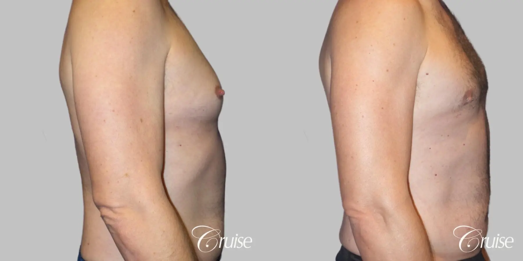 Best Gynecomastia surgeons Los Angeles - Before and After 3