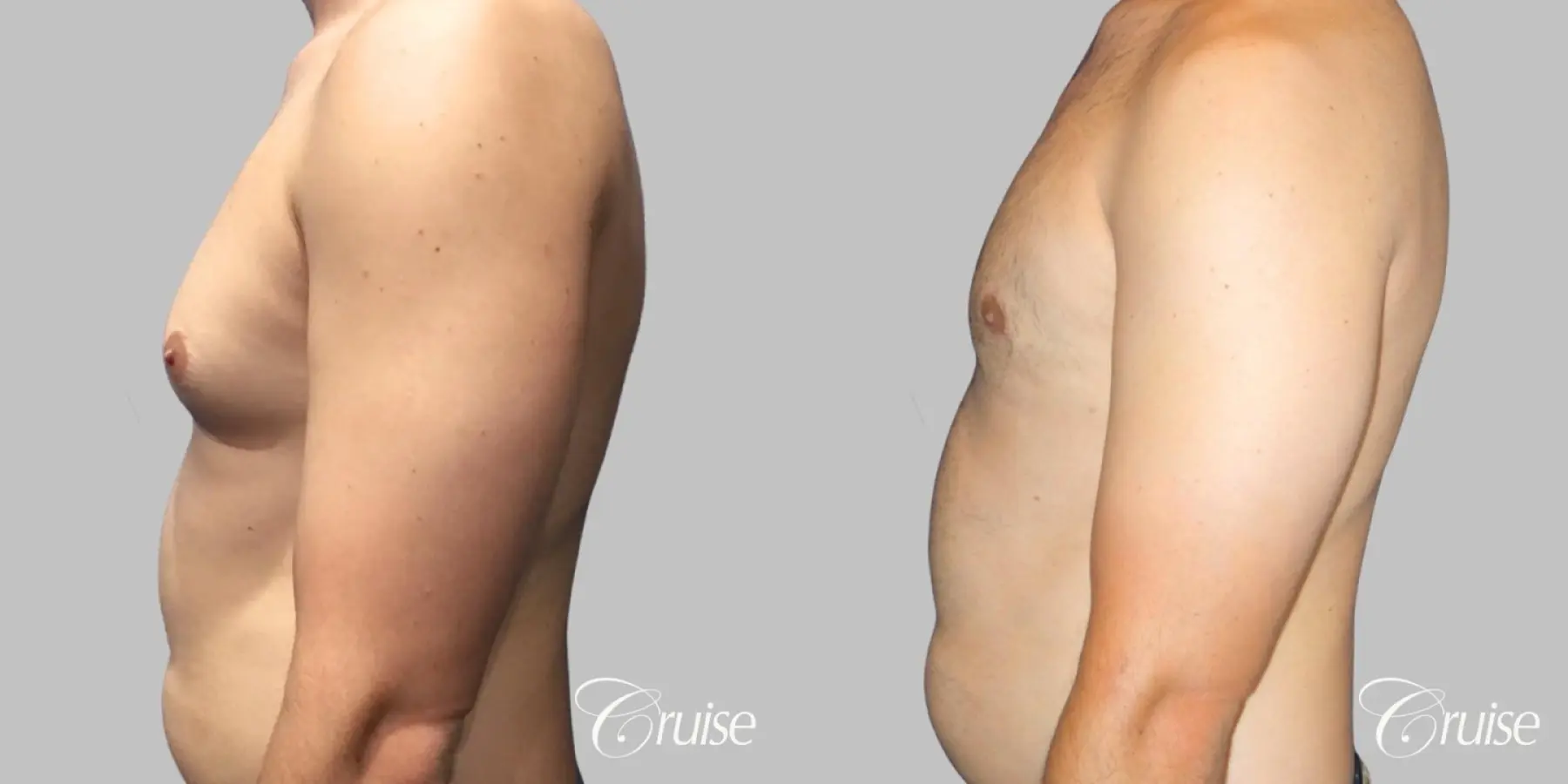 gyne before and after photos orange county ca - Before and After 3