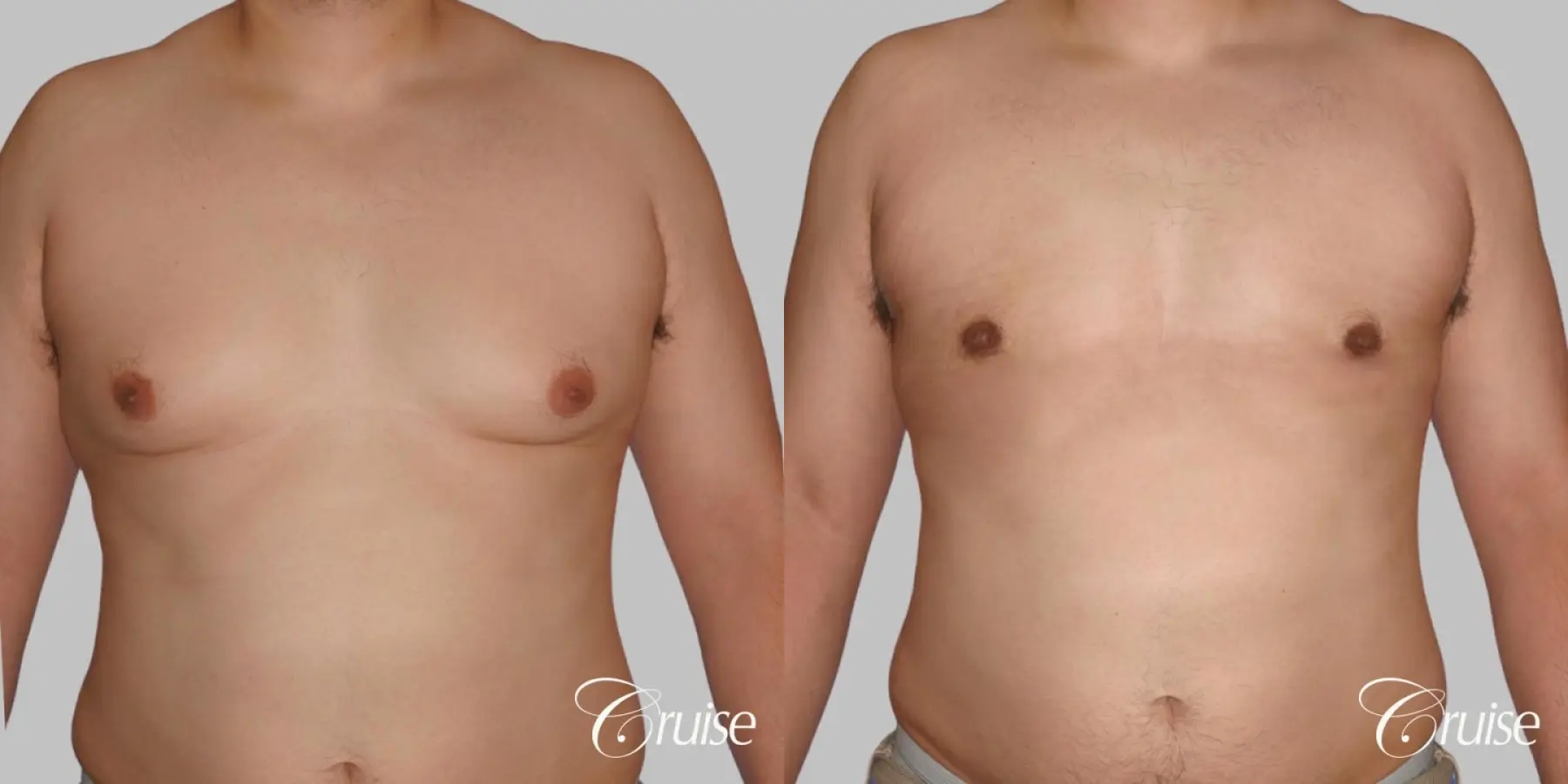 Type 3 Gynecomastia with Breast Roll Liposuction - Before and After  