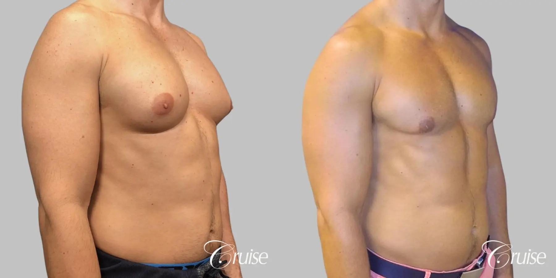 Gynecomastia - Type 3 (inferior + superior incisions) - Before and After 2