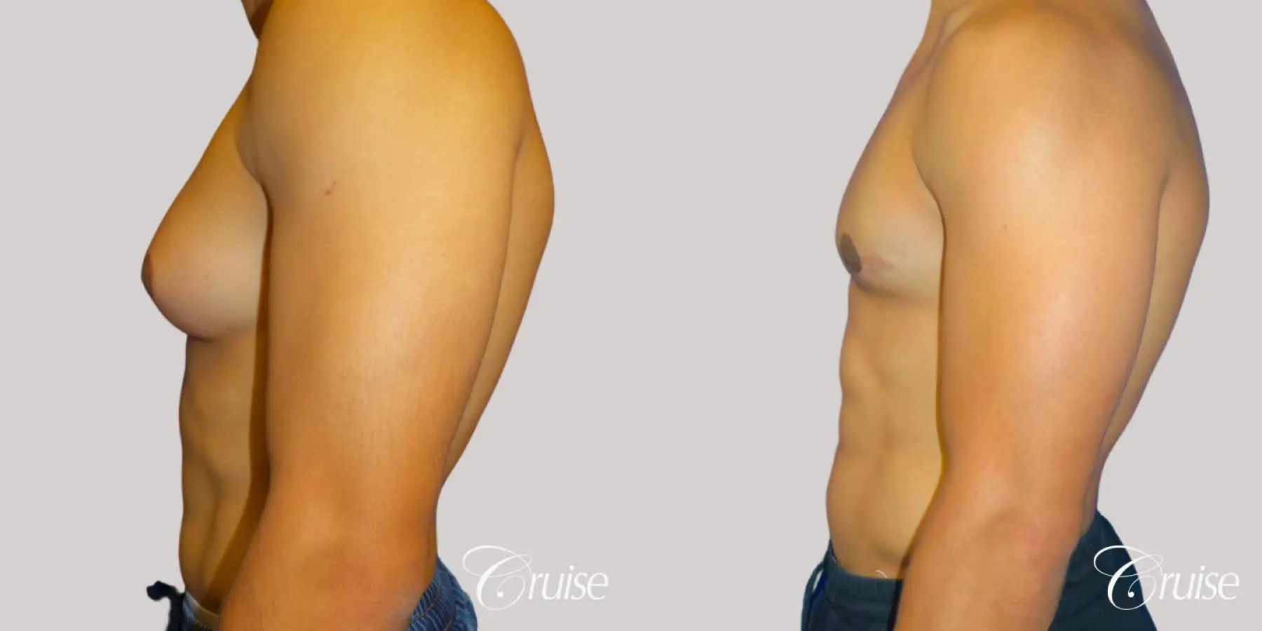 Unilateral gynecomastia before and after - Before and After 3