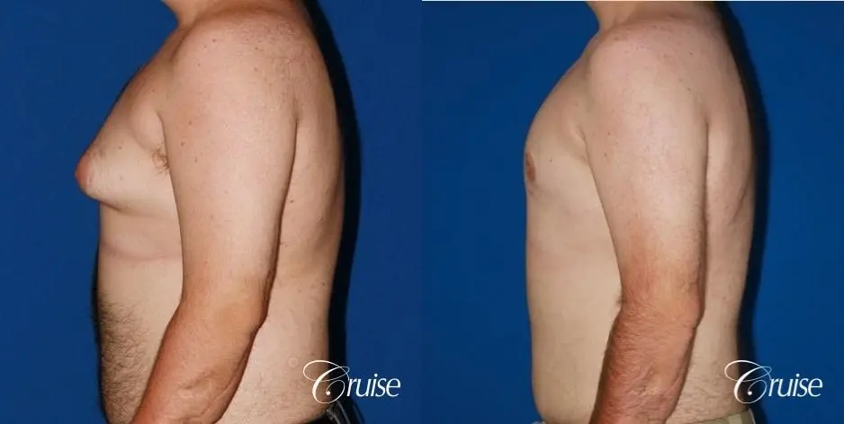 Gynecomastia Before & After Gallery: Patient 108