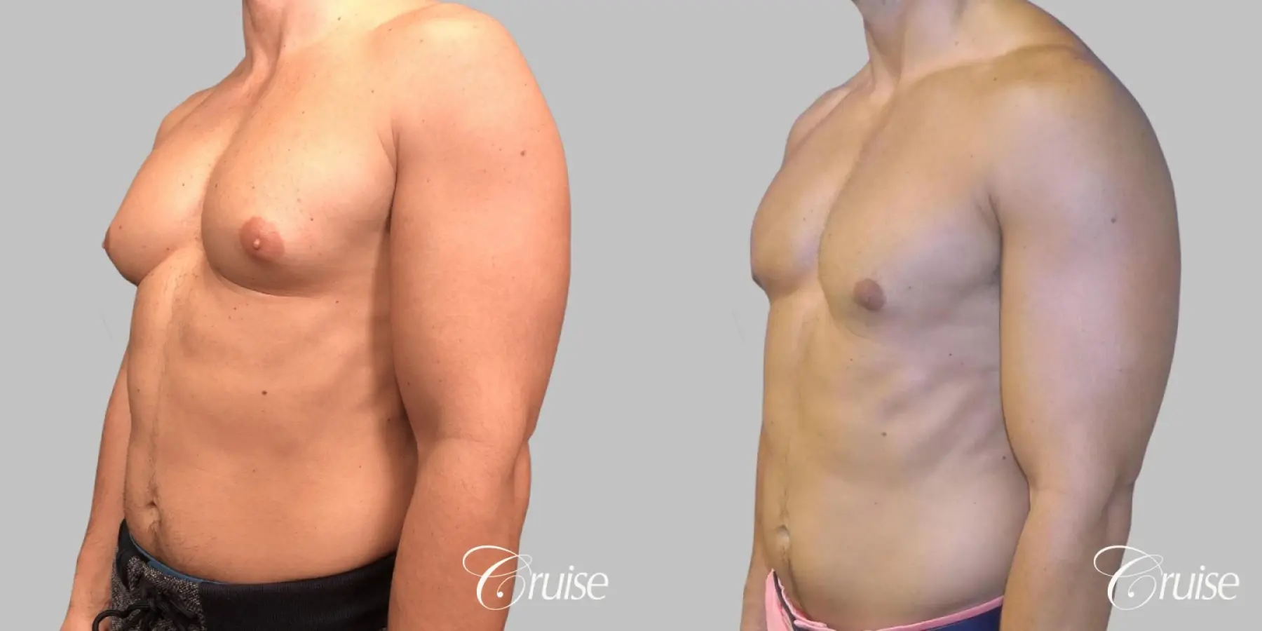 Gynecomastia - Type 3 (inferior + superior incisions) - Before and After 3