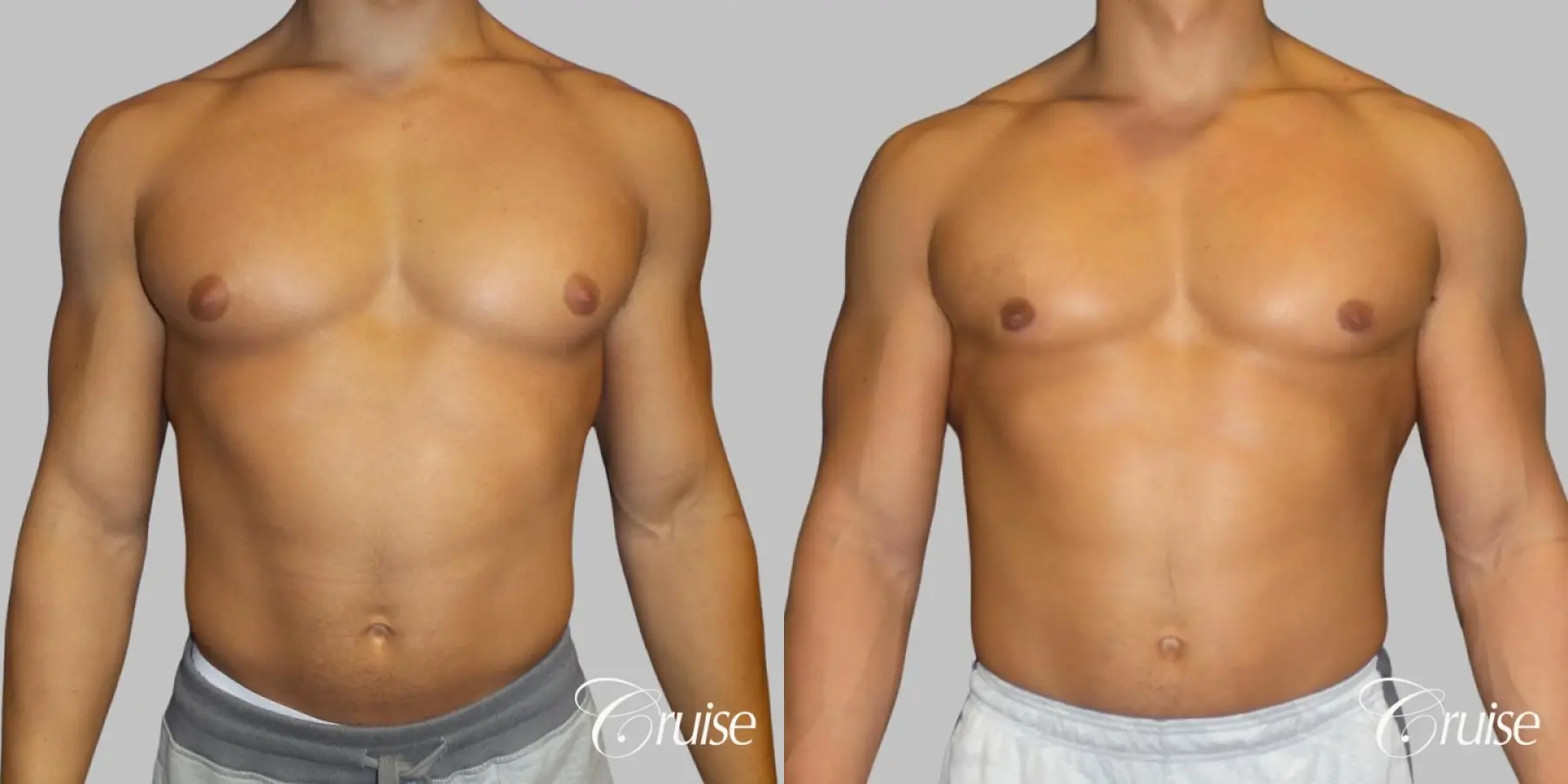 bodybuilder with gynecomastia - Before and After