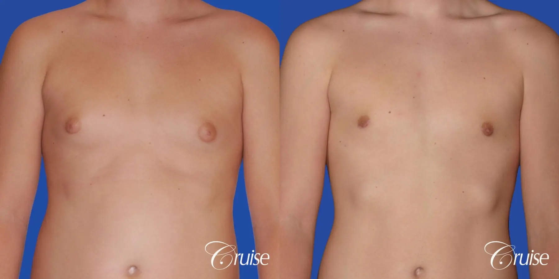 Gynecomastia Before & After Gallery: Patient 80