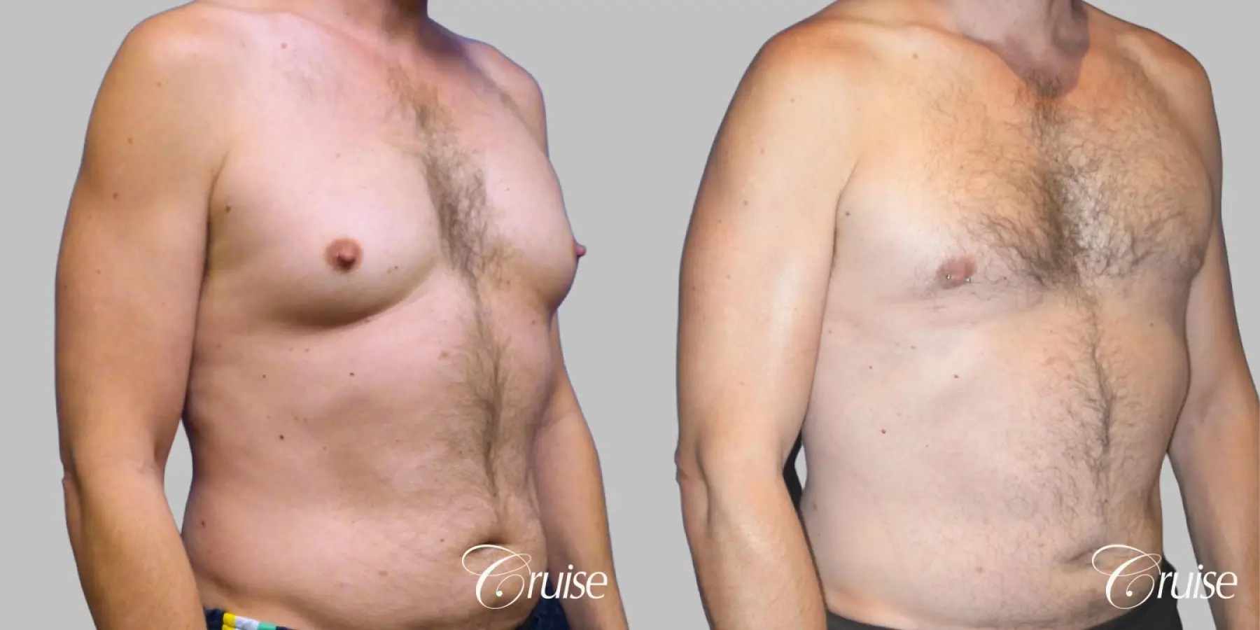 Best Gynecomastia surgeons Los Angeles - Before and After 2