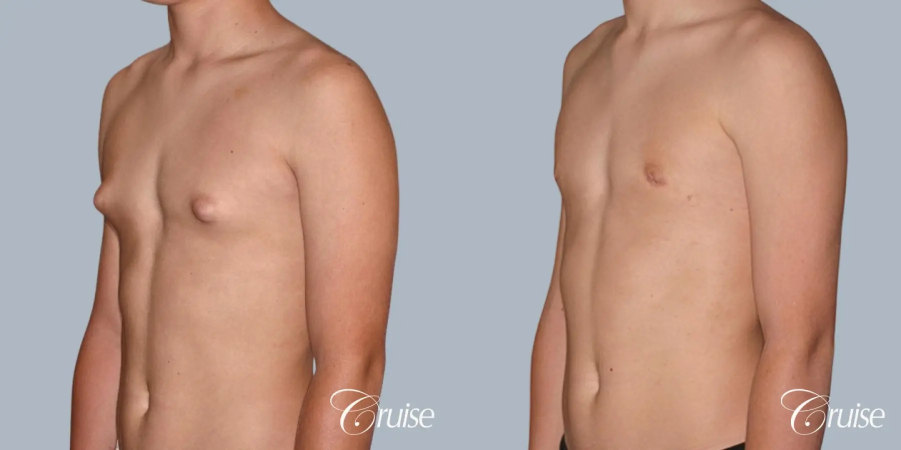 teenage gynecomastia with puffy nipple - Before and After 3