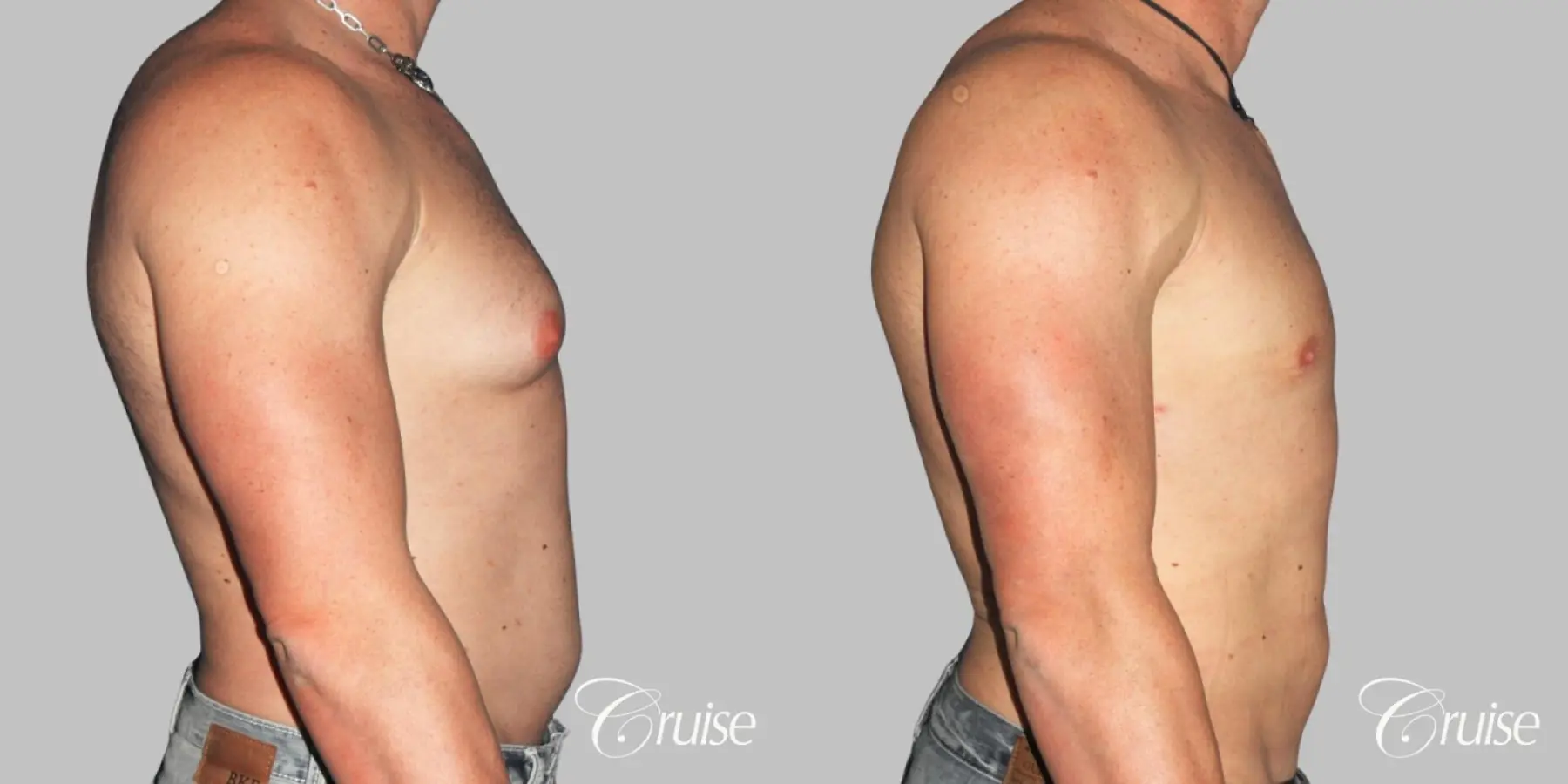 Athletic adult gynecomastia with glandular tissue removal - Before and After 3