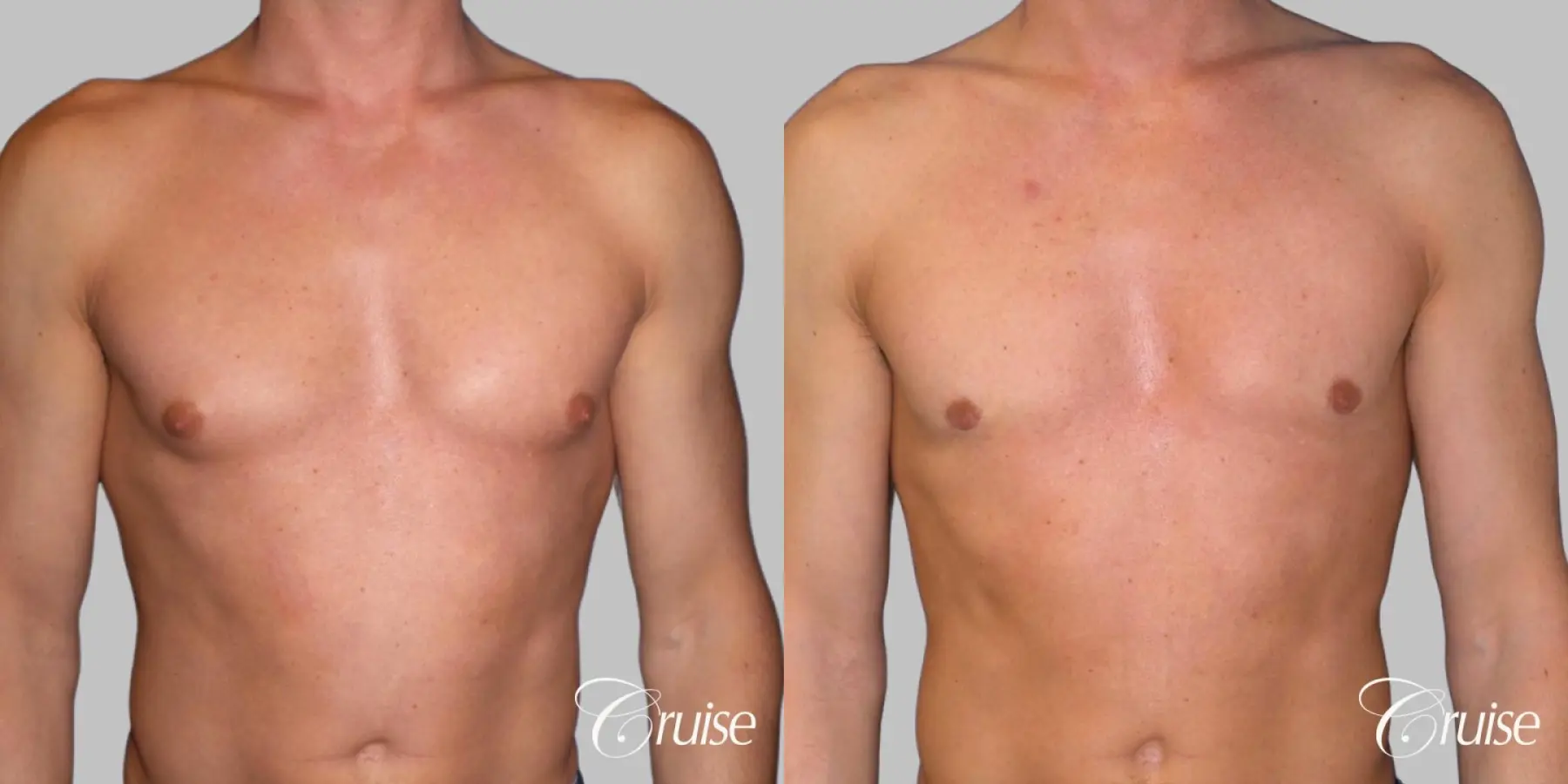 Type 1.5 Puffy Nipple Gynecomastia - Before and After 1