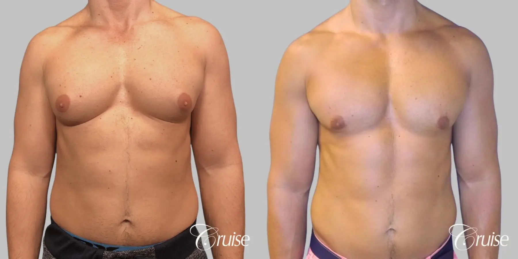 Gynecomastia - Type 3 (inferior + superior incisions) - Before and After  