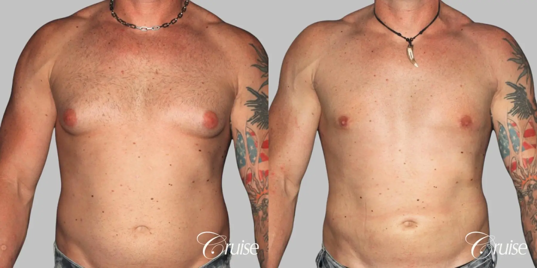 Athletic adult gynecomastia with glandular tissue removal - Before and After 1