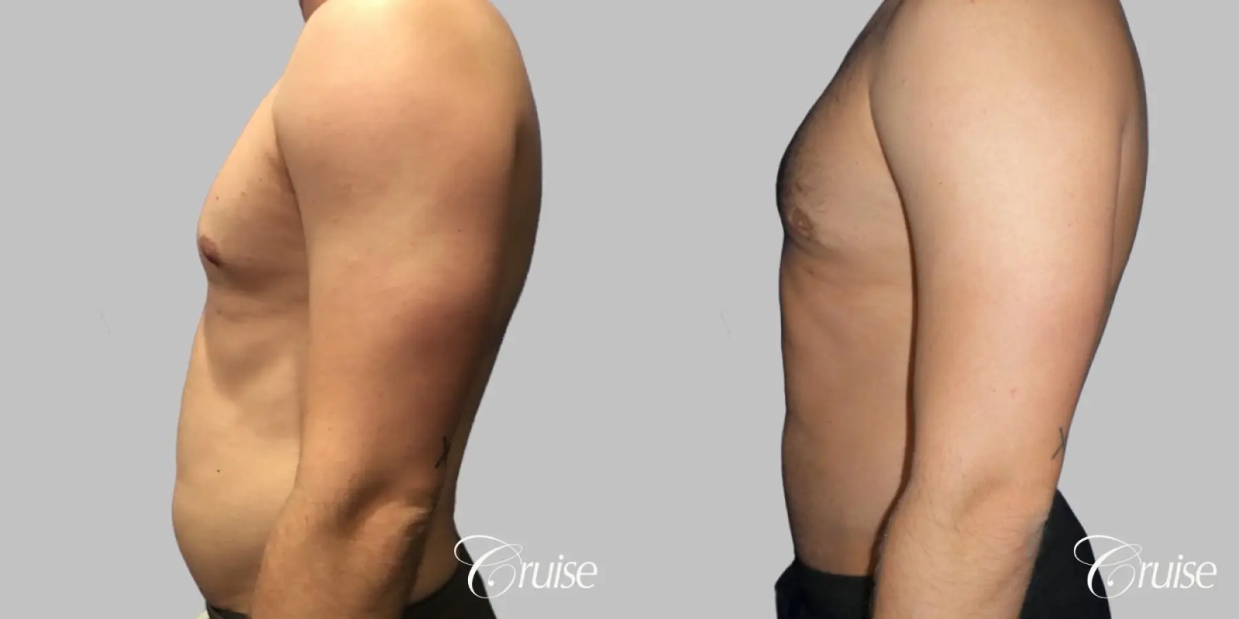 Type 2/3 Asymmetric Gynecomastia  - Before and After 4