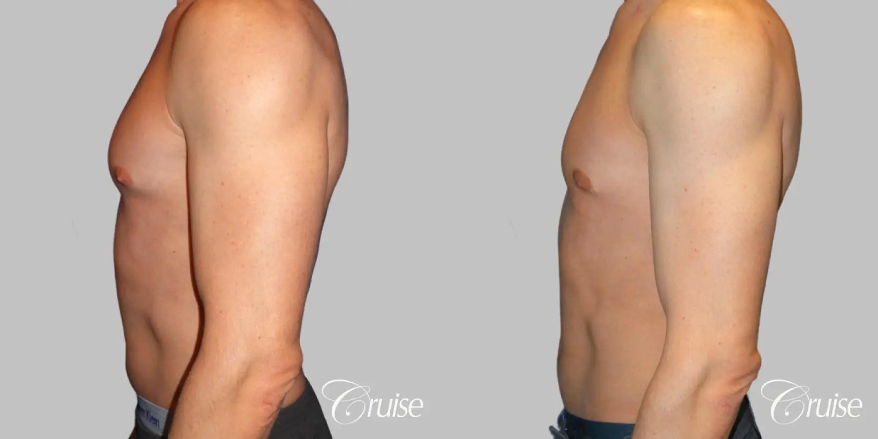 Type 1.5 Puffy Nipple Gynecomastia - Before and After 3