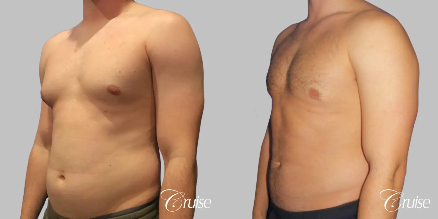 Type 2/3 Asymmetric Gynecomastia  - Before and After 2