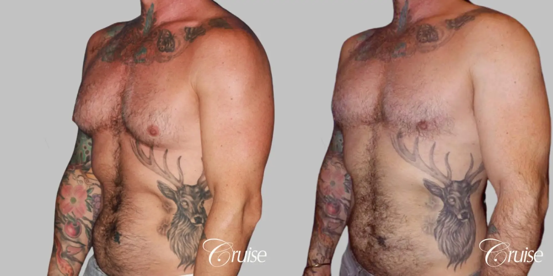 adult gynecomastia - Before and After 2