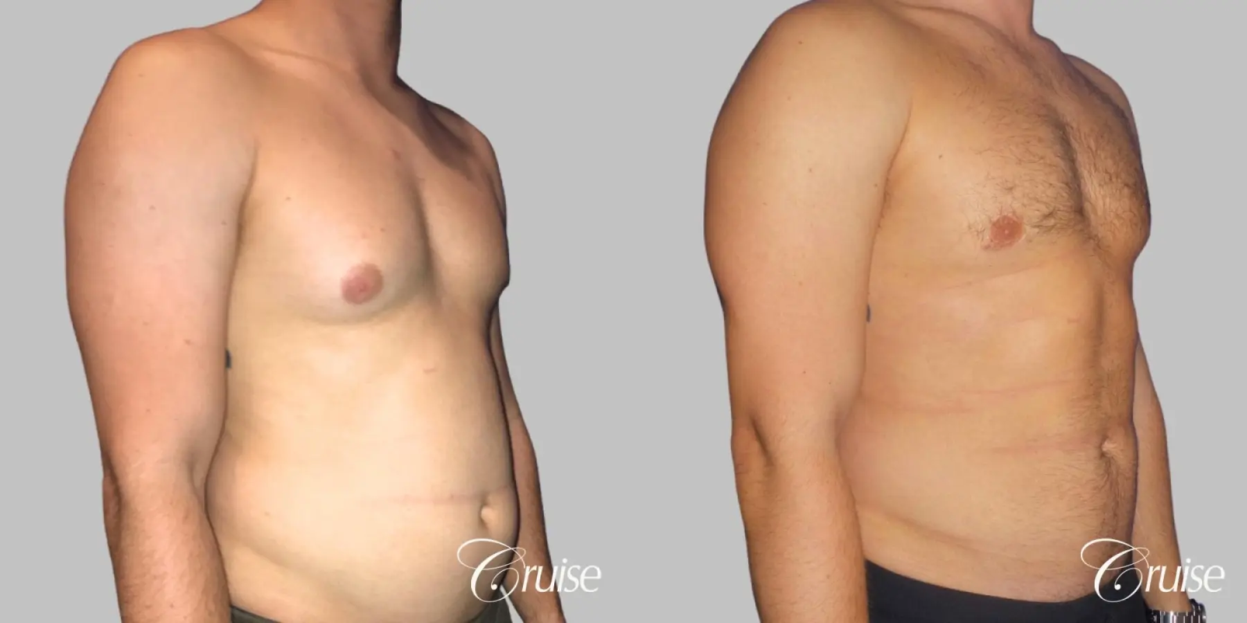 Type 2/3 Asymmetric Gynecomastia  - Before and After 3