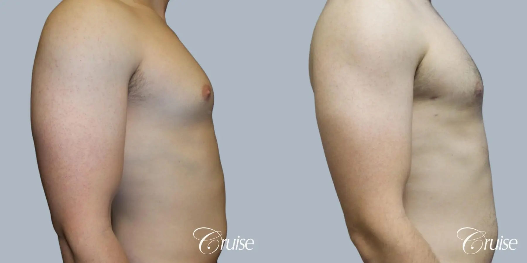 Adult gynecomastia before and after photos - Before and After 3