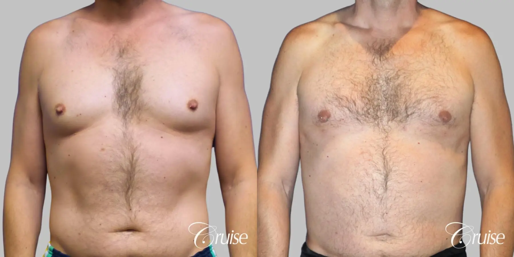 Best Gynecomastia surgeons Los Angeles - Before and After 1