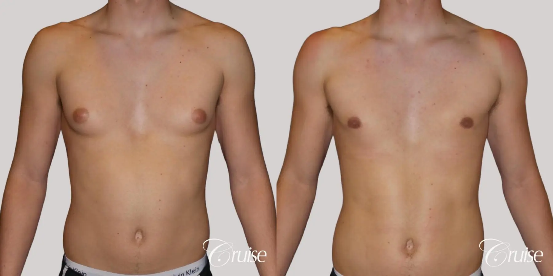 Best moderate gynecomastia on male adult - Before and After