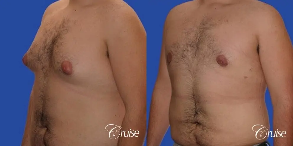 https://www.bragbook.gallery/assets/gallery/220/gynecomastia-before-and-after-q8uL0nkq2pj1_highres.webp
