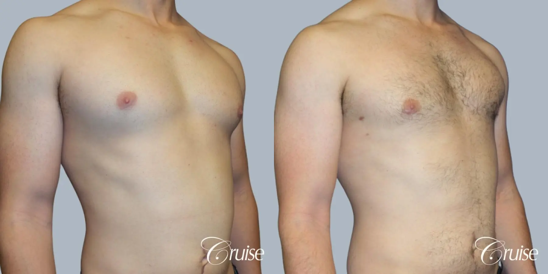 Adult gynecomastia before and after photos - Before and After 2