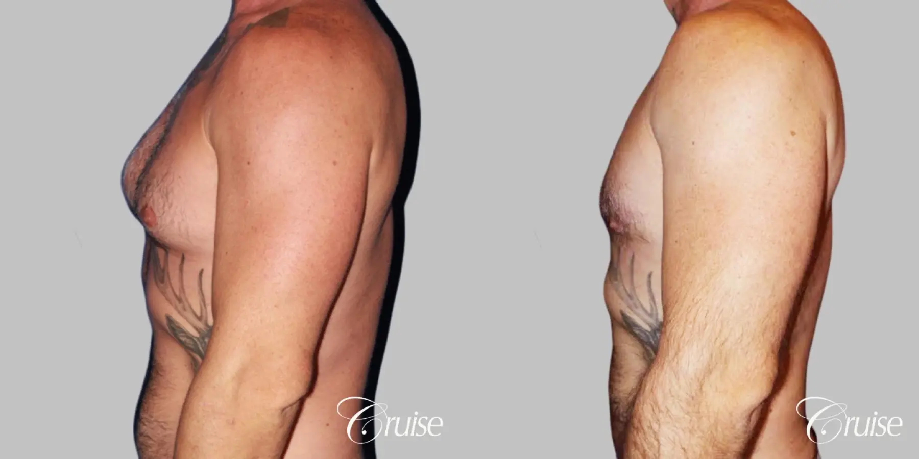 adult gynecomastia - Before and After 3